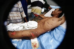 Wounds inflicted on man by Saltwater Crocodile (Crocodylus porosus) Wounds inflicted on man by Saltwater Crocodile (Crocodylus porosus)