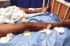 Wounds inflicted on man by Saltwater Crocodile (Crocodylus porosus) Wounds inflicted on man by Saltwater Crocodile (Crocodylus porosus)